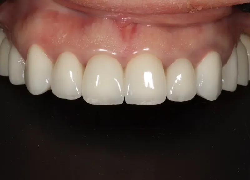 A complete upper and lower smile after treatment