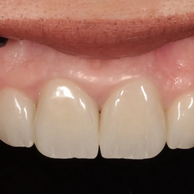 A restored upper smile after treatment