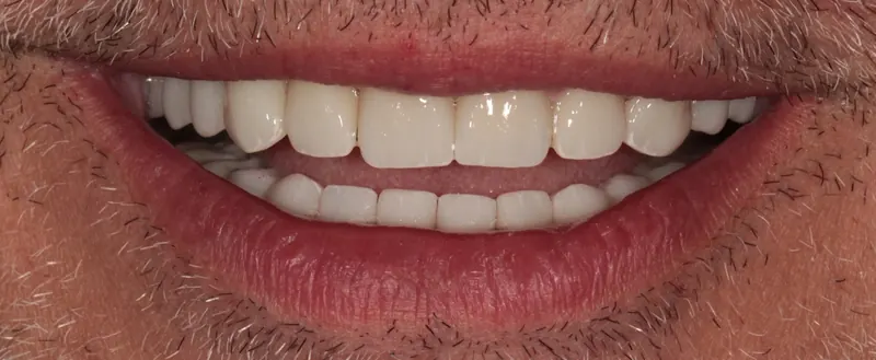 A full, even smile after treatment