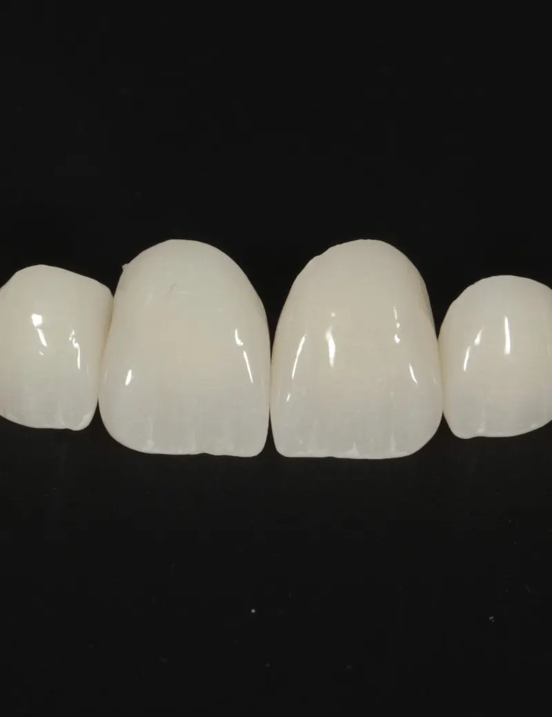 Ceramic crowns made for a LIT Dental patient, on black