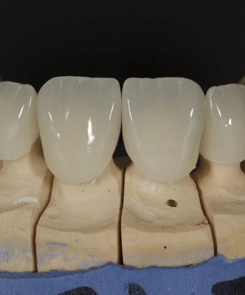 New crowns fitted on a dental model