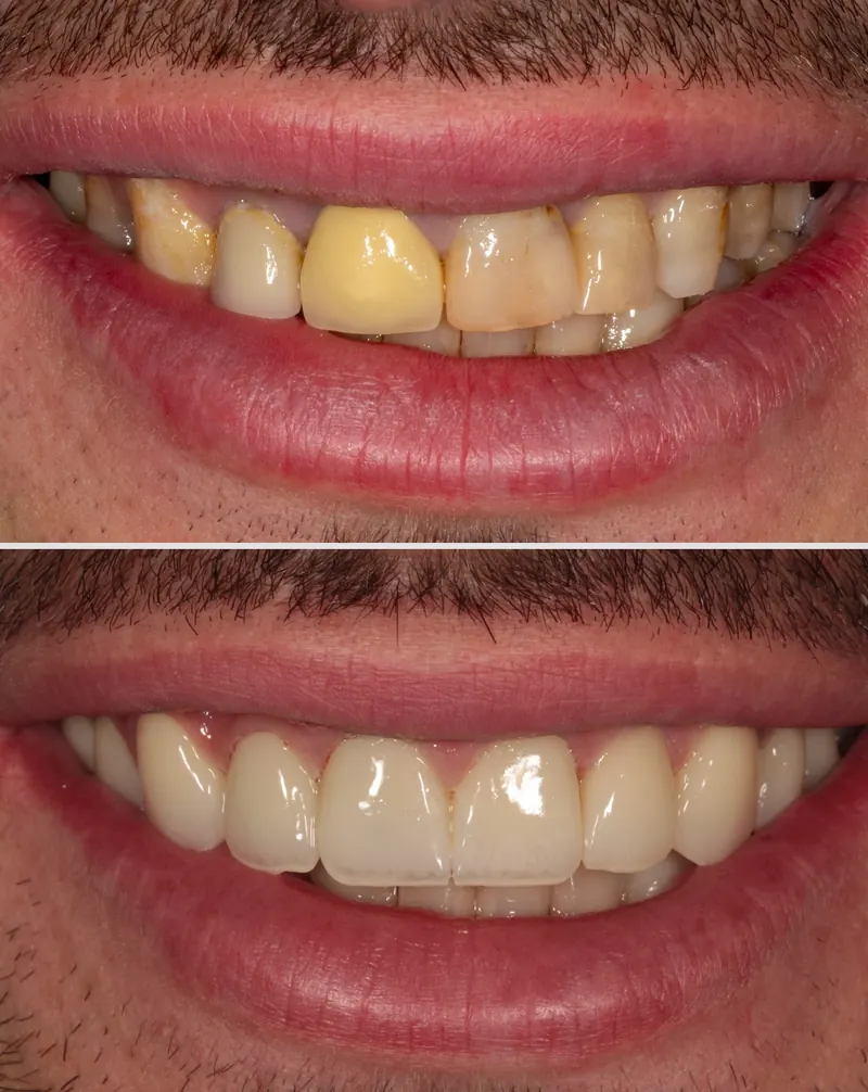Before and after: discoloured front teeth restored to an even, bright smile