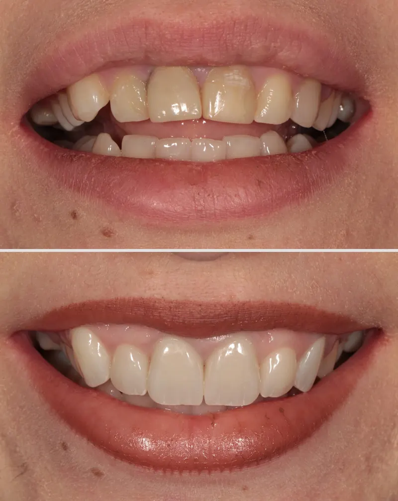 Before and after: uneven front teeth aligned into a natural smile