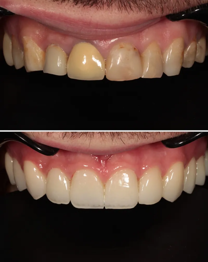 Before and after: worn, stained upper teeth replaced with a bright, even row