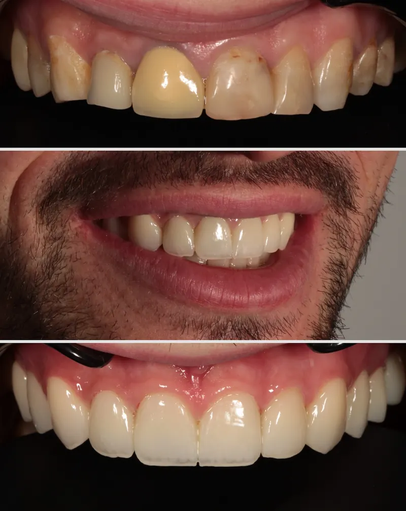 A patient's smile before and after treatment at LIT Dental